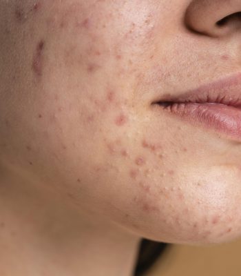 confident-young-woman-with-acne-close-up-scaled.jpg
