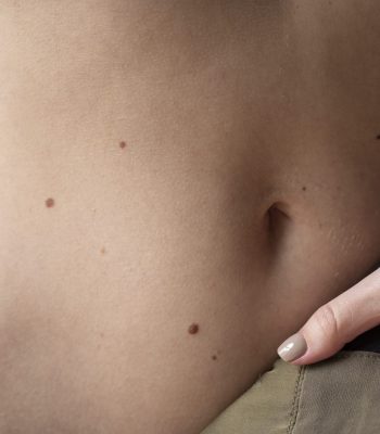 mujer-melanoma-piel-scaled.jpg