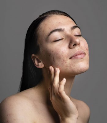 retrato-mujer-joven-confiado-acne-scaled.jpg